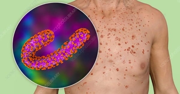 Marburg Ethiopia Arsi