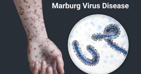 Marburg Virus in Ethiopia